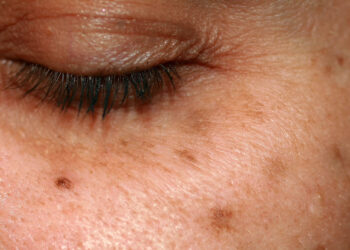 Slip hurtigt af med alderspletter med dette enkle hjemmemiddel